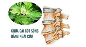 chữa gai cột sống bằng ngải cứu